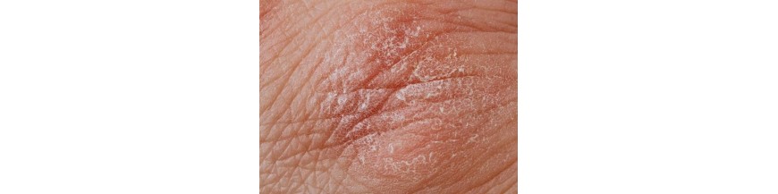 Vendita Online di Farmaci per Dermatiti, Ustioni e Punture