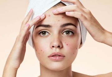 Acne: principali cause e rimedi