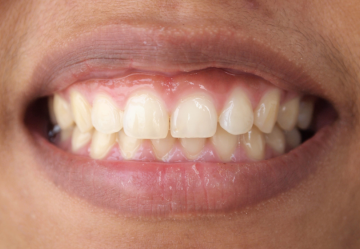 Bruxismo diurno: cause e rimedi