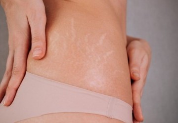 Come eliminare le smagliature
