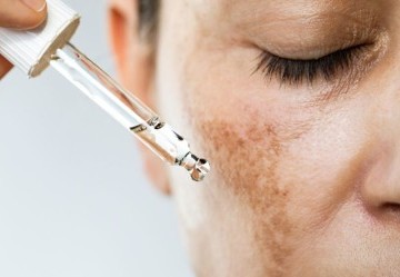 Come si elimina il melasma?