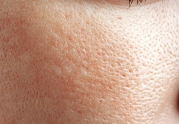 Pori dilatati: cause e rimedi efficaci