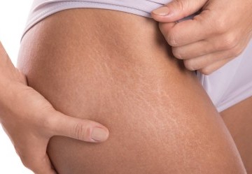 Eliminare le smagliature in estate: i rimedi più efficaci