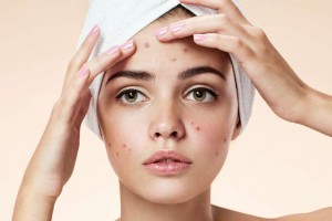 Acne: principali cause e rimedi